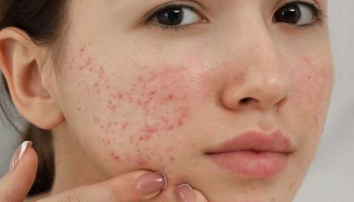 Acne-Pimples-Treatment