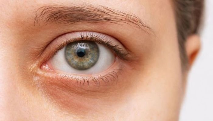 Dark-Circle-Reduction