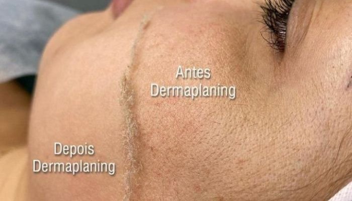 Dermaplaning