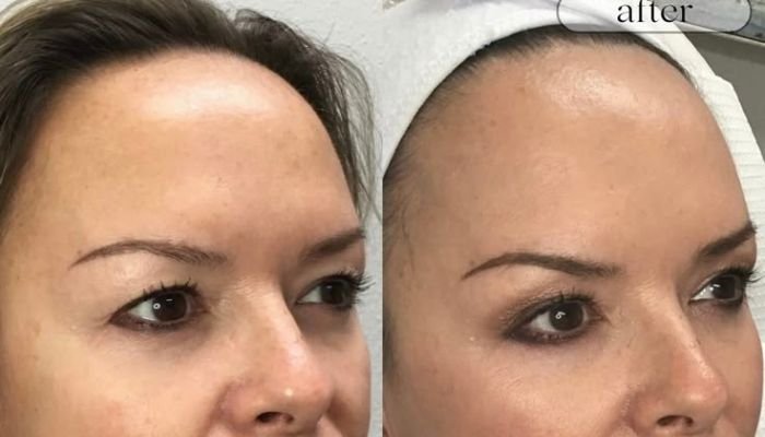 Face-Lifting-Wrinkle-Reduction