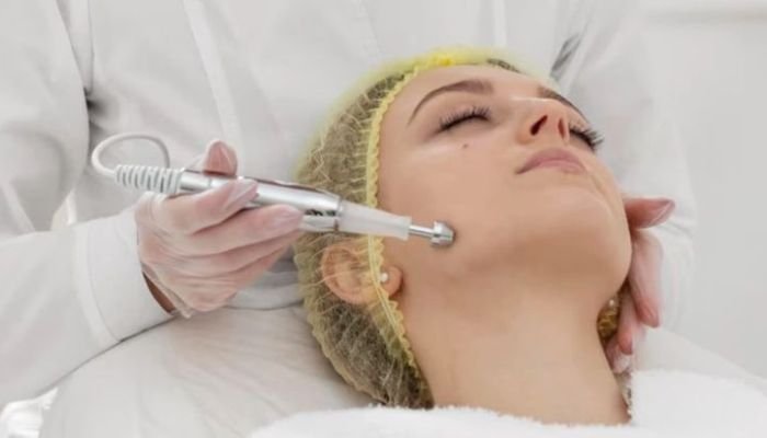 MNRF-Treatment-Microneedling-RF