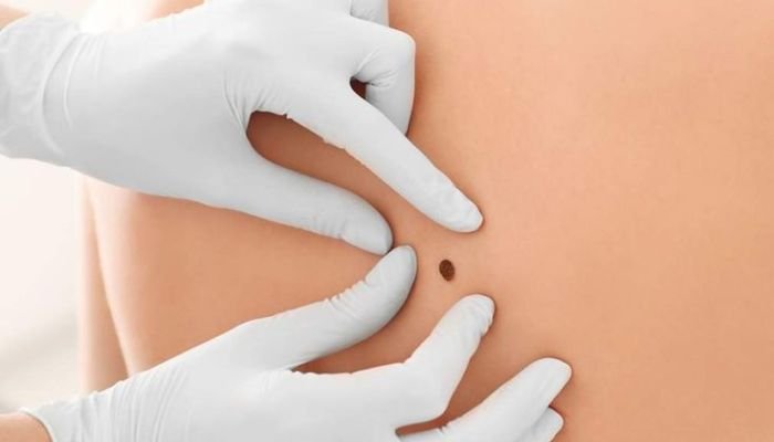 Removing-Skin-Growths-Warts-Moles-Skin-Tags