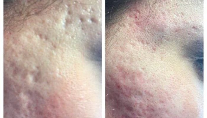 Scar-Correction-Microneedling-PRP
